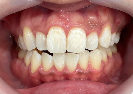 ホワイトニング後の歯の色