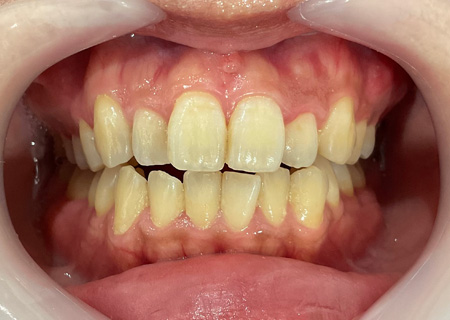 ホワイトニング前の歯の色